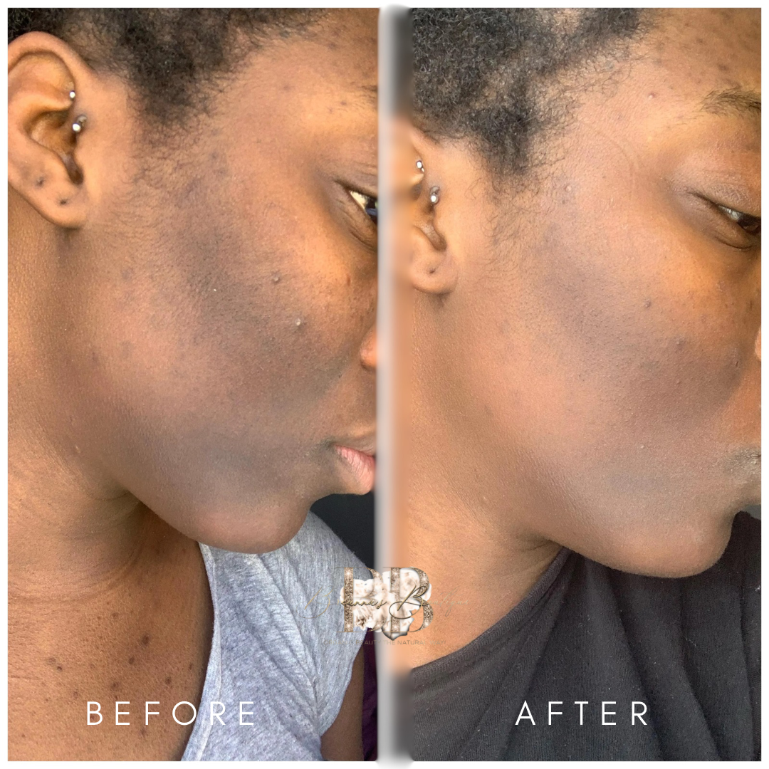 Hyper-Pigmentation Treatments Breanna’s Boutique 